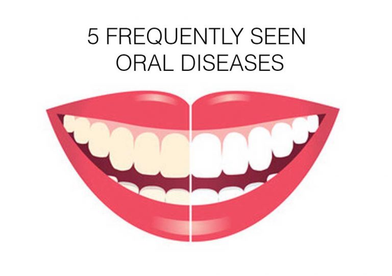 5 Frequently seen Oral Diseases | oral health