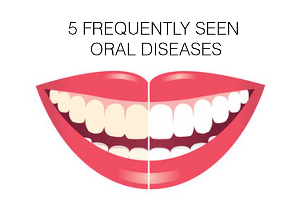 You are currently viewing 5 Frequently seen Oral Diseases | oral health